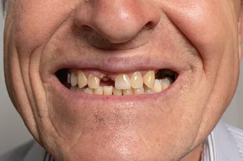 Chipped Teeth