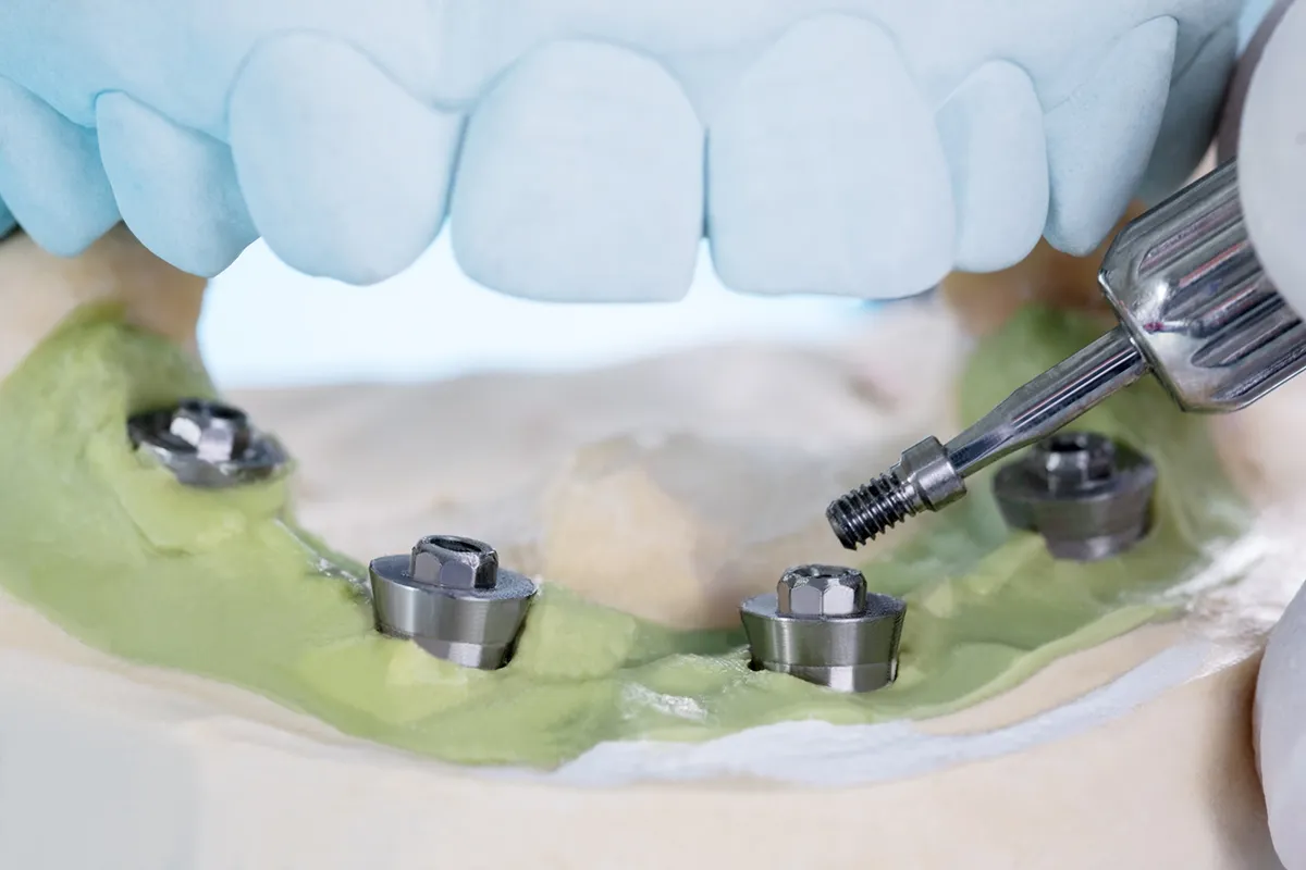 he cost of all-on-4 dental implants compared to other tooth replacement options.