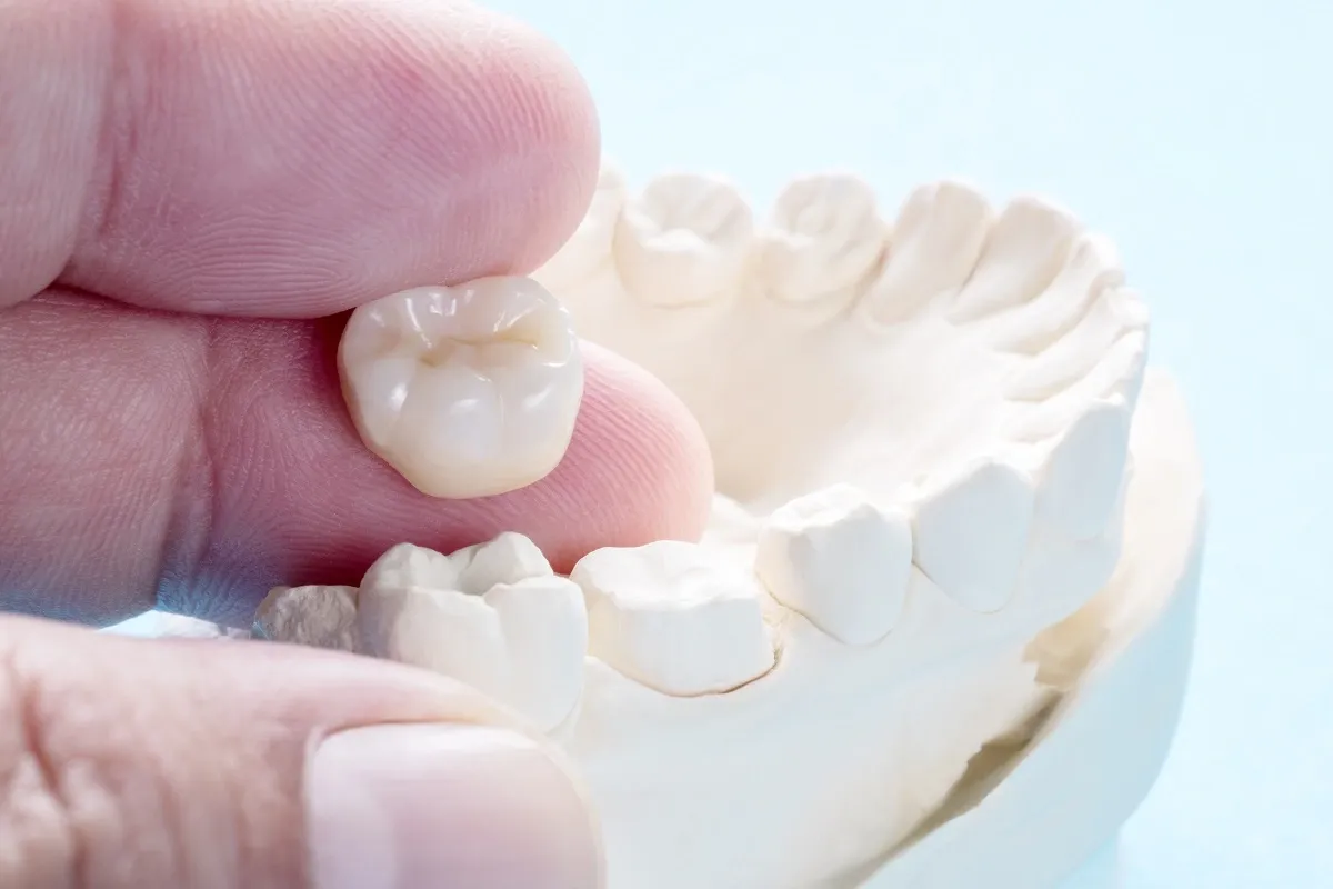 Choosing Dental Inlays: Understanding When They're the Ideal Solution
