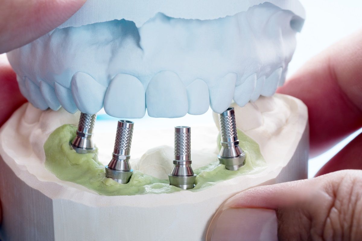 Smile Makeover with All-on-4 Dental Implants: Transforming Your Oral Health.