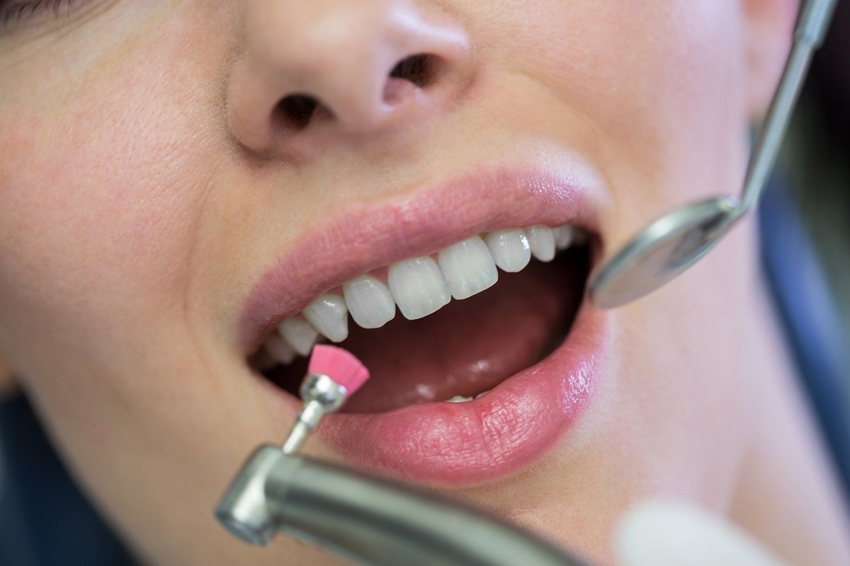 Smile Makeovers: Transforming your Teeth with Dental Crowns