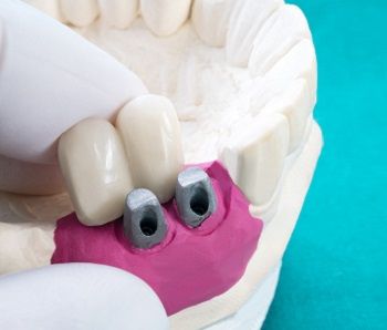 What to Expect from Dental Implants Bone Grafting?