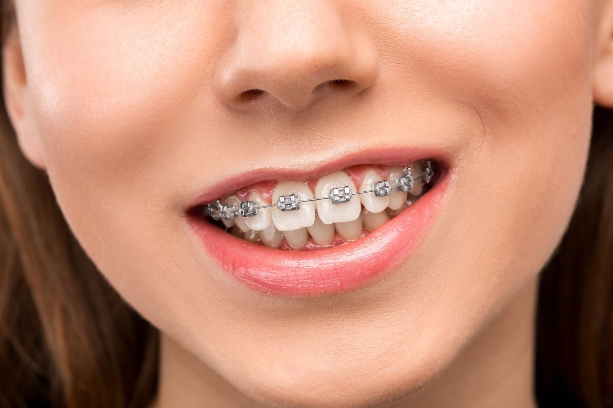 beautiful-young-woman-with-teeth-braces.jpg
